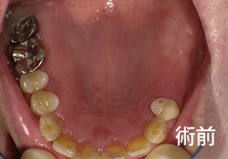 術前インプラント症例１