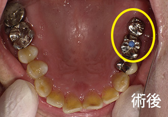 術前インプラント症例１