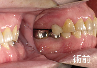 術前インプラント症例１