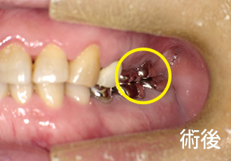 術前インプラント症例１