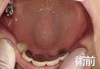 術前ノンクラスプデンチャー症例１