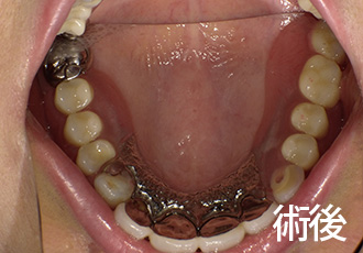 術後ノンクラスプデンチャー症例１