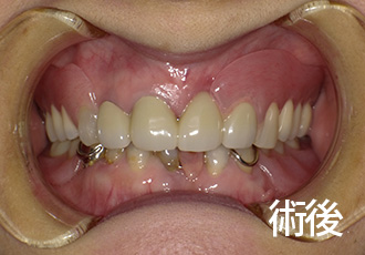 術後ノンクラスプデンチャー症例１